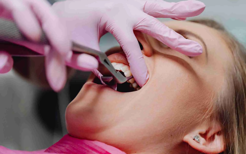 Link between tooth extraction and gum disease