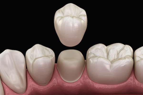 What To Ask Your General Dentist When Preparing for a Crown from Coronado Dentistry & Pediatrics in Coronado, CA