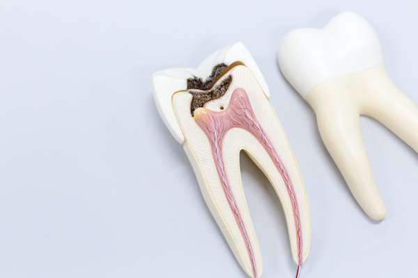 Ask a General Dentist: Is a Tooth Dead After a Root Canal from Coronado Dentistry & Pediatrics in Coronado, CA