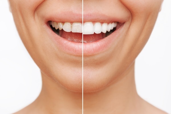 How Dental Bonding Can Strengthen Your Teeth