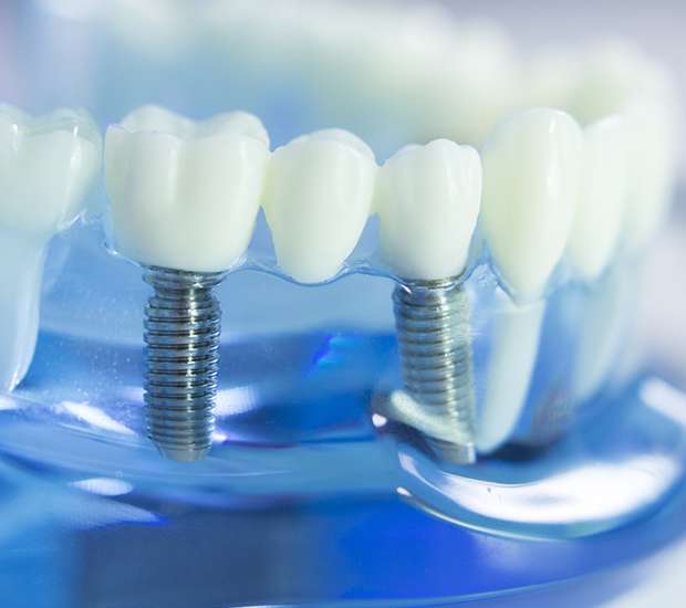 Coronado Dental Implants