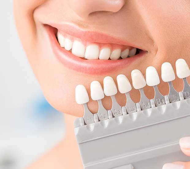 Coronado Dental Veneers and Dental Laminates